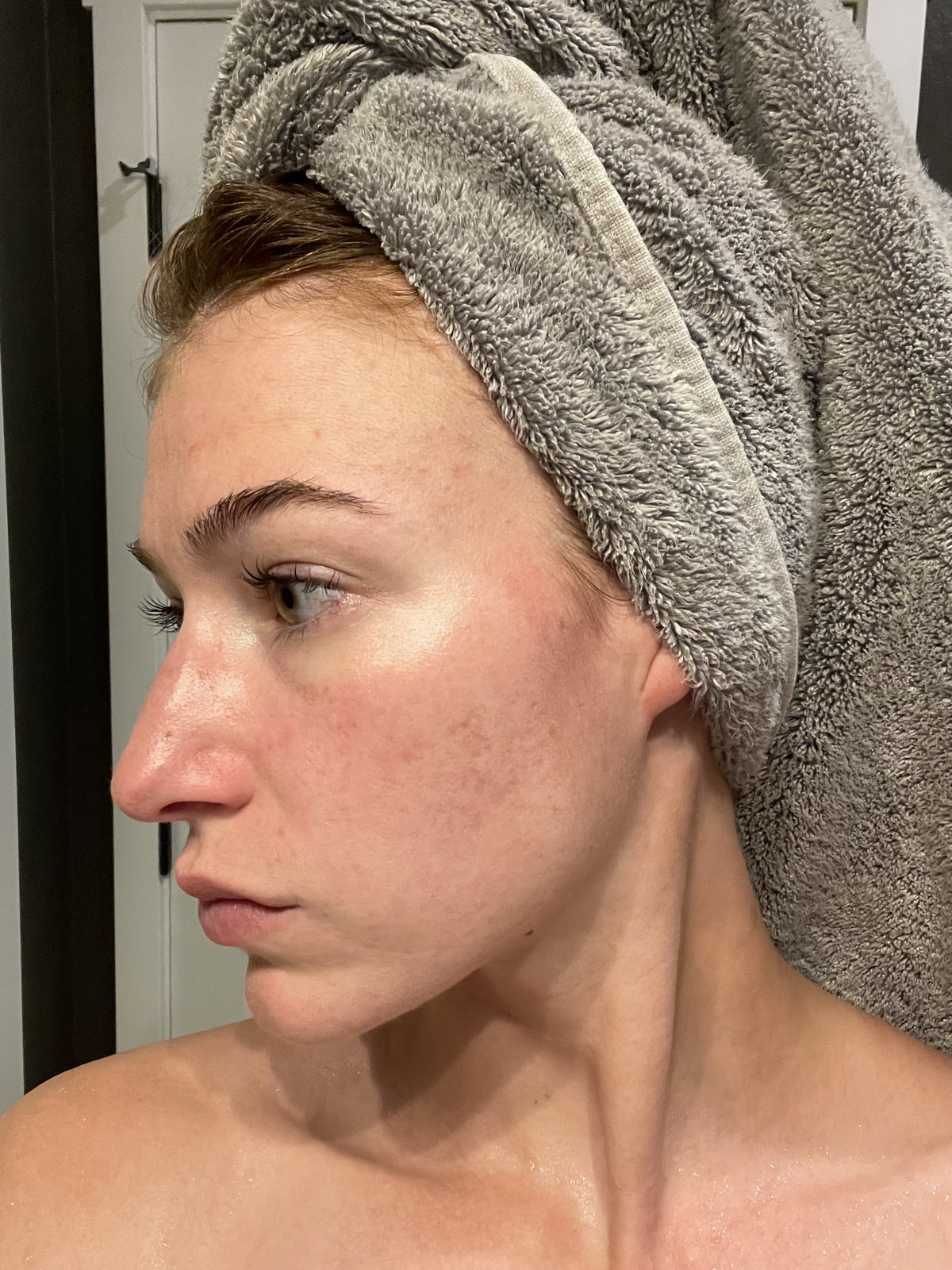 My skin after one month on Accutane