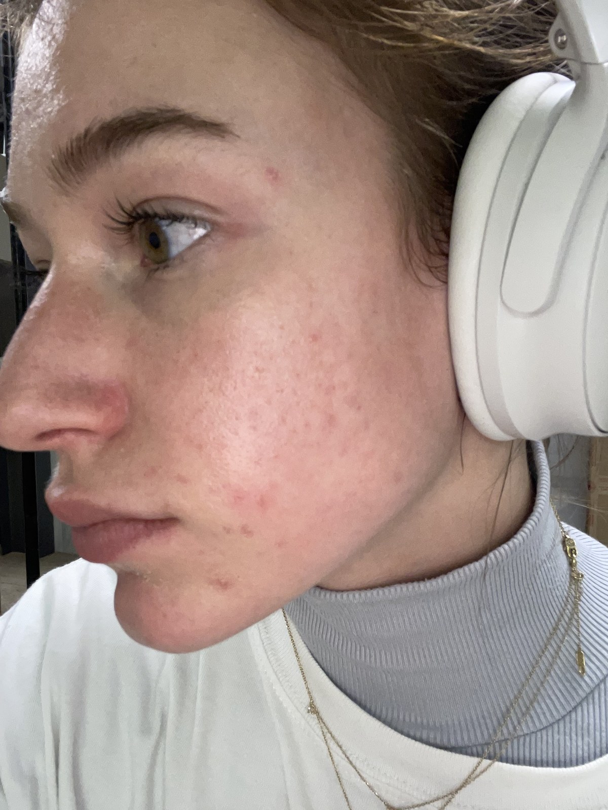 My skin 45 days into tretinoin