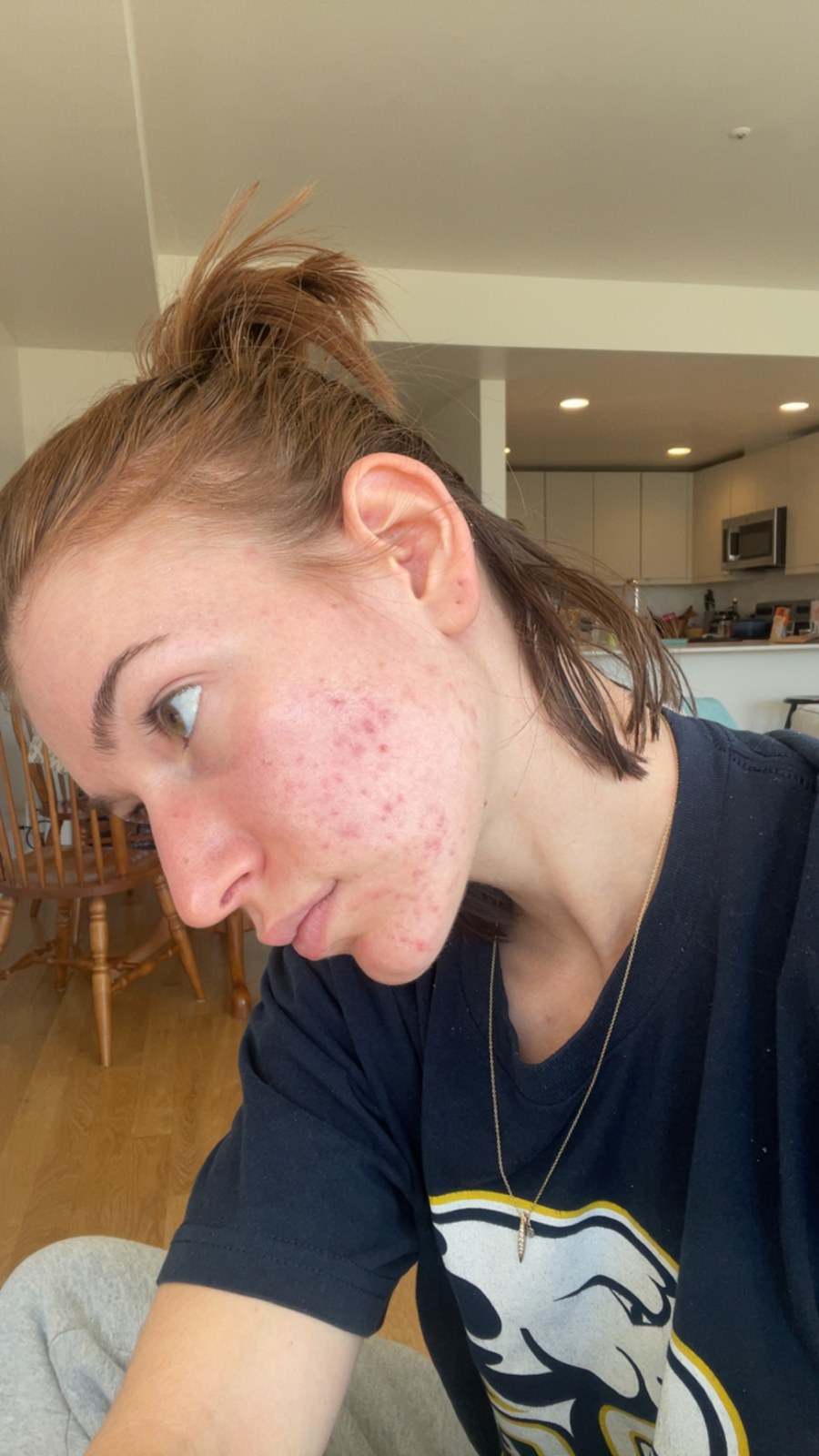 My skin after six months on tretinoin